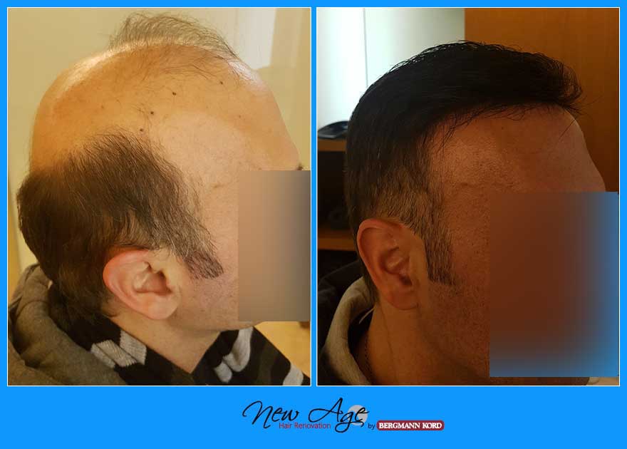 wigs-hair-prosthesis-new-age-bergmann-kord-hair-clinics-results-men-before-after-035670PG-002