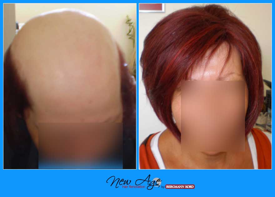 wigs-hair-prosthesis-new-age-bergmann-kord-hair-clinics-results-women-before-after-010112PG-001