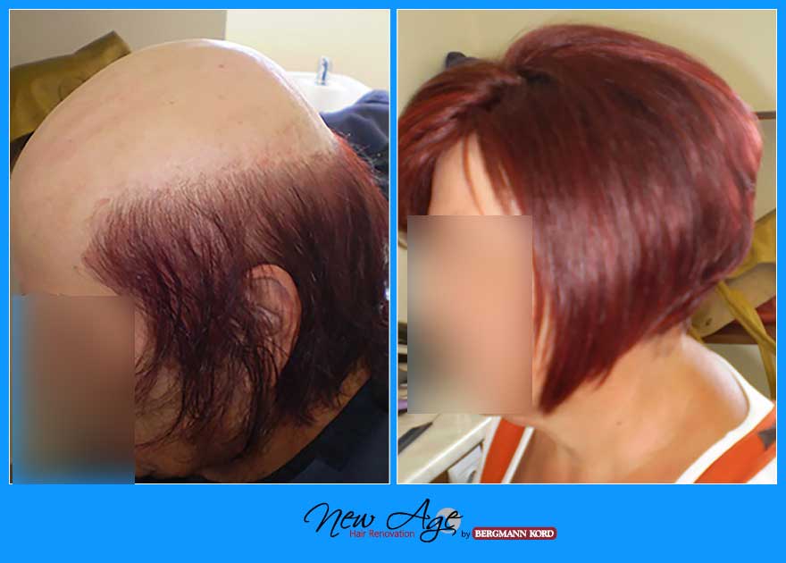 wigs-hair-prosthesis-new-age-bergmann-kord-hair-clinics-results-women-before-after-010112PG-002