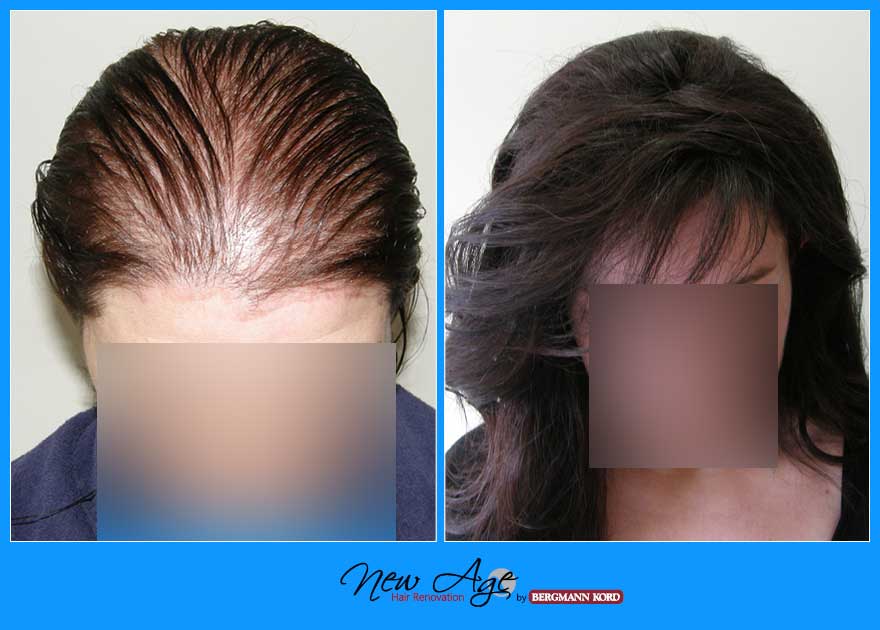 wigs-hair-prosthesis-new-age-bergmann-kord-hair-clinics-results-women-before-after-010803PG-001