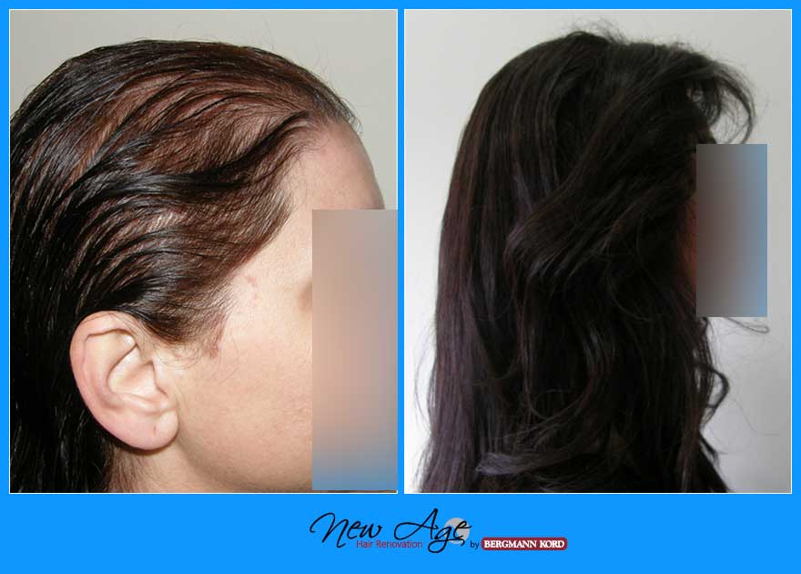 wigs-hair-prosthesis-new-age-bergmann-kord-hair-clinics-results-women-before-after-010803PG-002