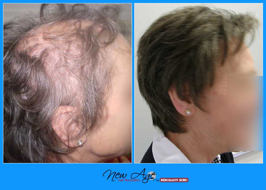wigs-hair-prosthesis-new-age-bergmann-kord-hair-clinics-results-women-before-after-020212PG-001