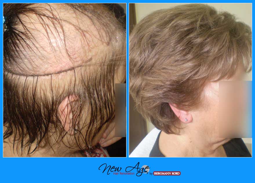 wigs-hair-prosthesis-new-age-bergmann-kord-hair-clinics-results-women-before-after-020212PG-002