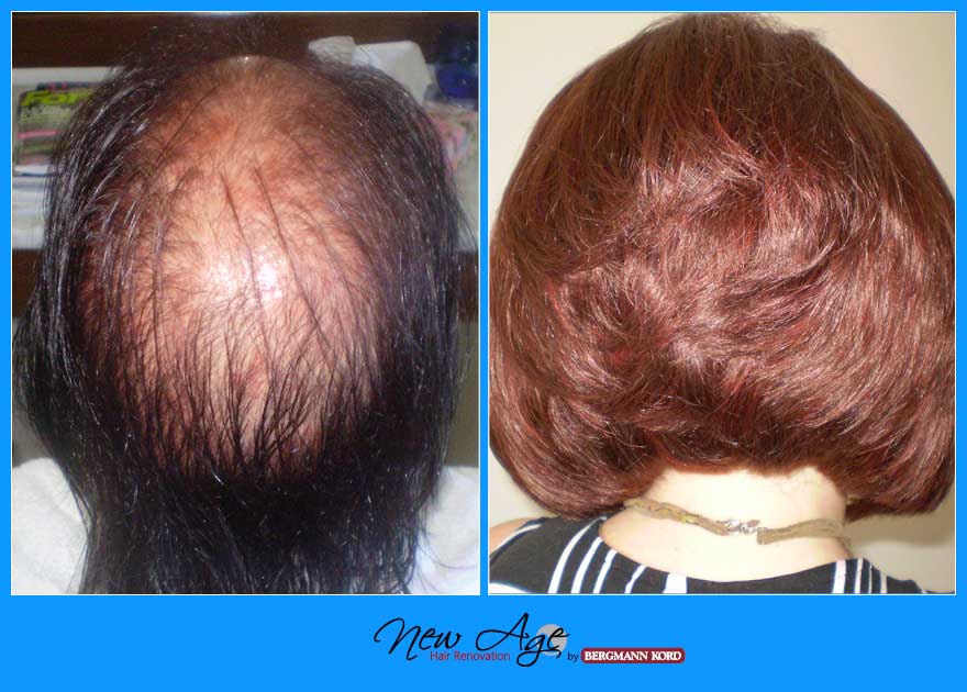 wigs-hair-prosthesis-new-age-bergmann-kord-hair-clinics-results-women-before-after-020291PG-001