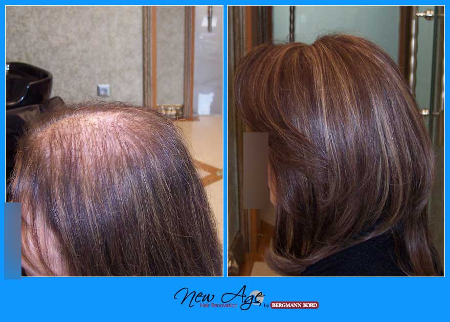 wigs-hair-prosthesis-new-age-bergmann-kord-hair-clinics-results-women-before-after-027061PG-001