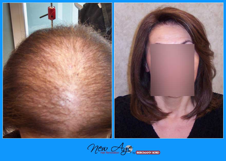 wigs-hair-prosthesis-new-age-bergmann-kord-hair-clinics-results-women-before-after-027061PG-002