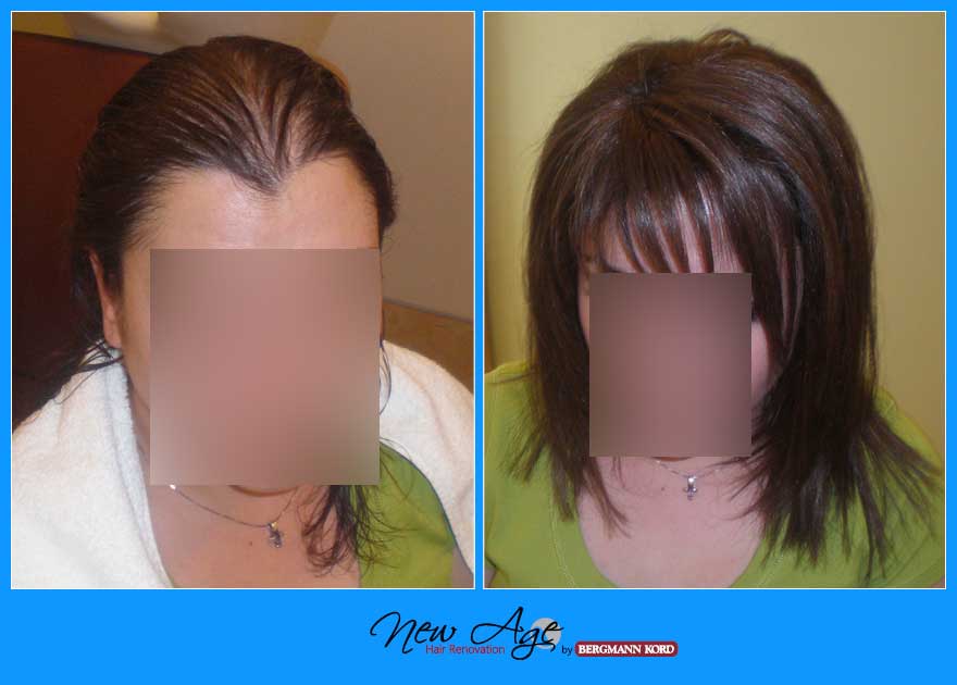 wigs-hair-prosthesis-new-age-bergmann-kord-hair-clinics-results-women-before-after-043040PG-001