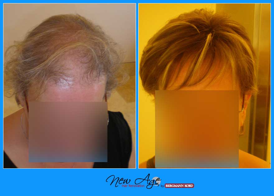 wigs-hair-prosthesis-new-age-bergmann-kord-hair-clinics-results-women-before-after-065098PG-001
