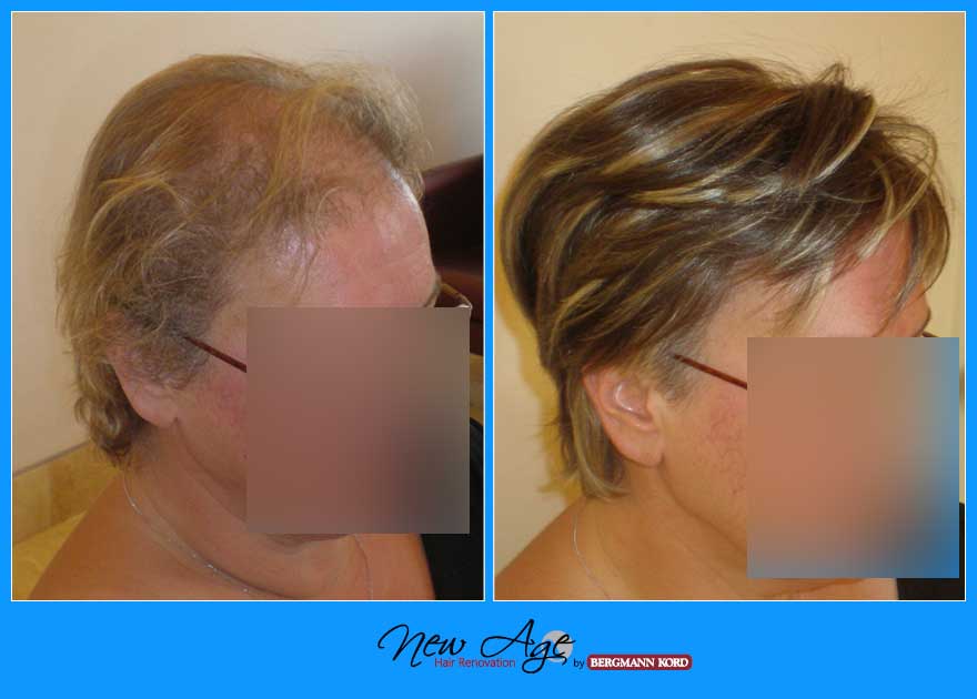 wigs-hair-prosthesis-new-age-bergmann-kord-hair-clinics-results-women-before-after-065098PG-002