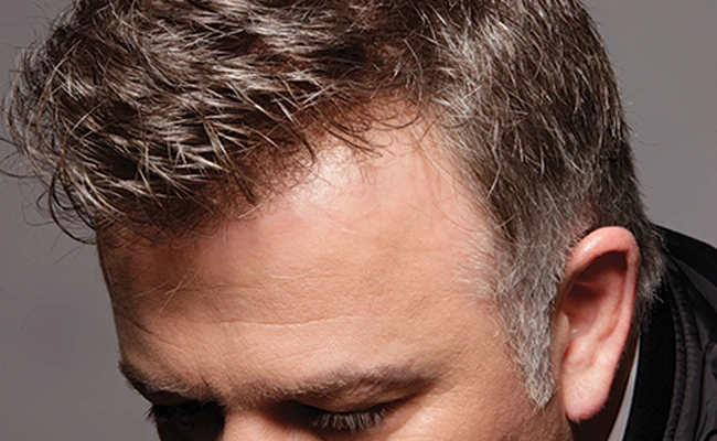 Σύστημα μαλλιών σε άνδρα με απόλυτα φυσικό αποτέλεσμα